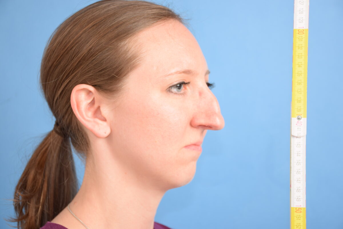 Rhinoplastik Prof. Ralf Siegert Nasenkorrektur & NasenOP
